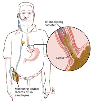 24hr-oesophageal-ph